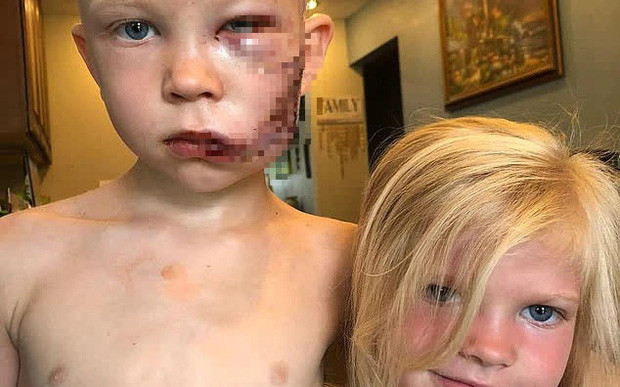 Cậu bé 6 tuổi phải khâu 90 mũi vì cứu em gái thoát khỏi chó dữ và khuôn mặt hiện tại gây xúc động mạnh