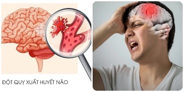 3 ngày trước khi bị nhồi máu não, 90% bệnh nhân đều làm 3 điều này