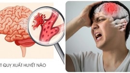 3 ngày trước khi bị nhồi máu não, 90% bệnh nhân đều làm 3 điều này